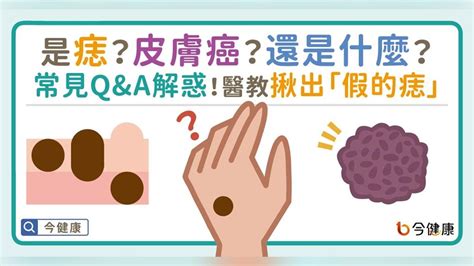 紅色痣代表什麼|是痣？皮膚癌？還是什麼？常見Q&A解惑！醫教揪出「。